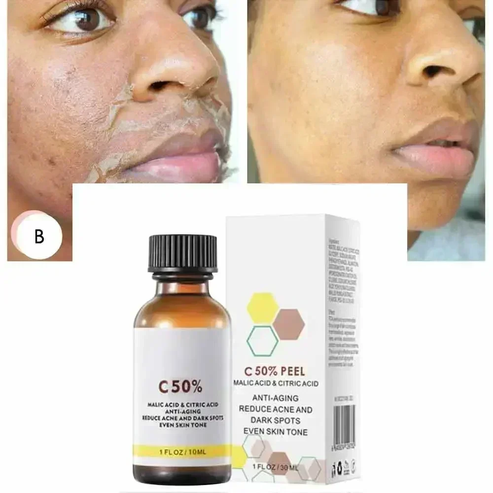 Ácido salicílico rosto casca f - Skincare Salicylic Acid avaliação e preço