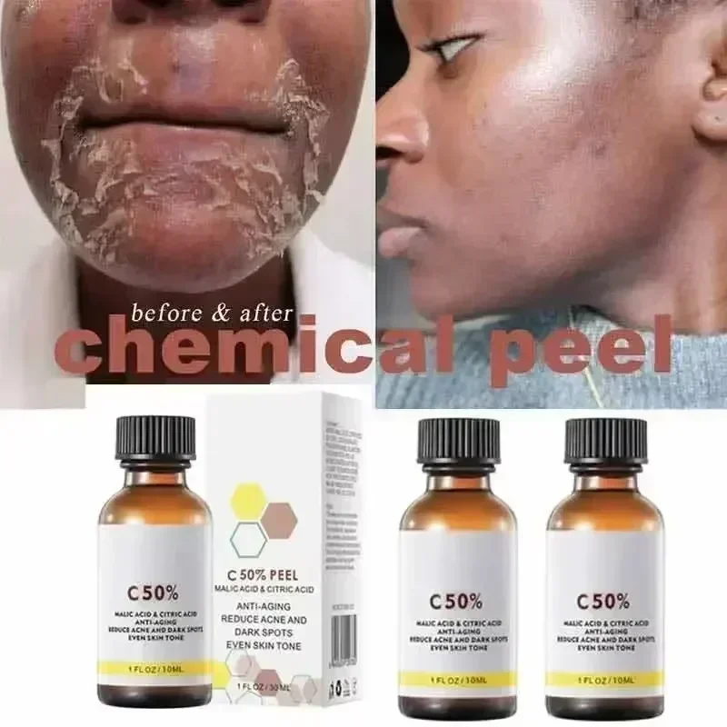 Ácido salicílico rosto casca f - Skincare Salicylic Acid avaliação e preço