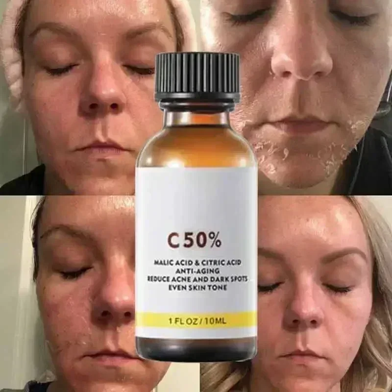 Ácido salicílico rosto casca f - Skincare Salicylic Acid avaliação e preço
