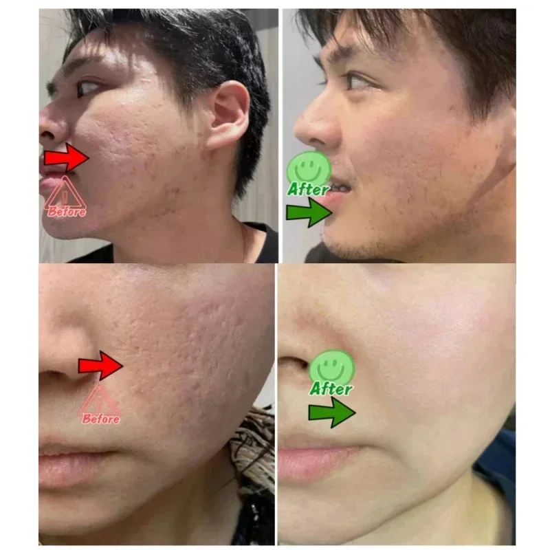 Ácido salicílico poros limpeza - Skincare Salicylic Acid avaliação e preço
