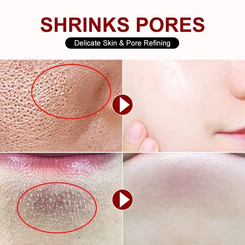 Ácido Salicílico Poro Shrinkin - Skincare Salicylic Acid avaliação e preço